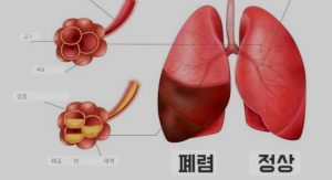 🎈폐렴 발생하는 이유.