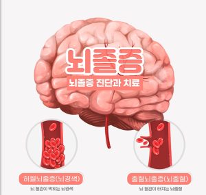 ♥️무서운 뇌졸증♡♥️